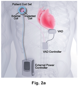 figure 2a animation of minnetronix transcutaneous energy transfer system tets