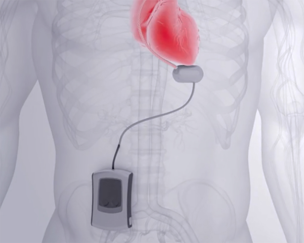 Minnetronix Medical Percutaneous VAD Power and Control configuration