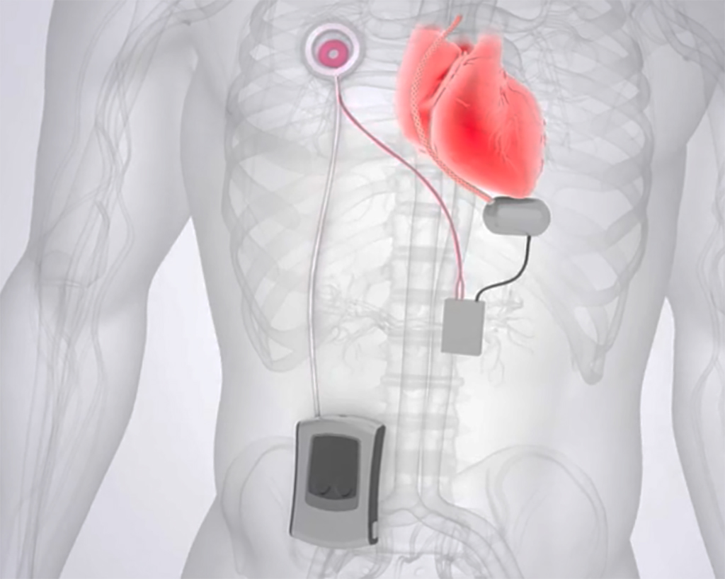 Minnetronix Medical Transcutaneous Energy Transmission Technology